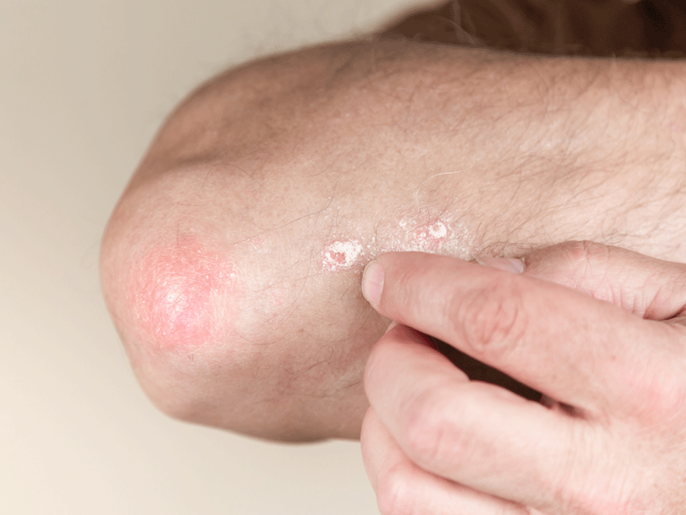 Prejavy seboroickej dermatitídy na lakti šupiny na pokožke