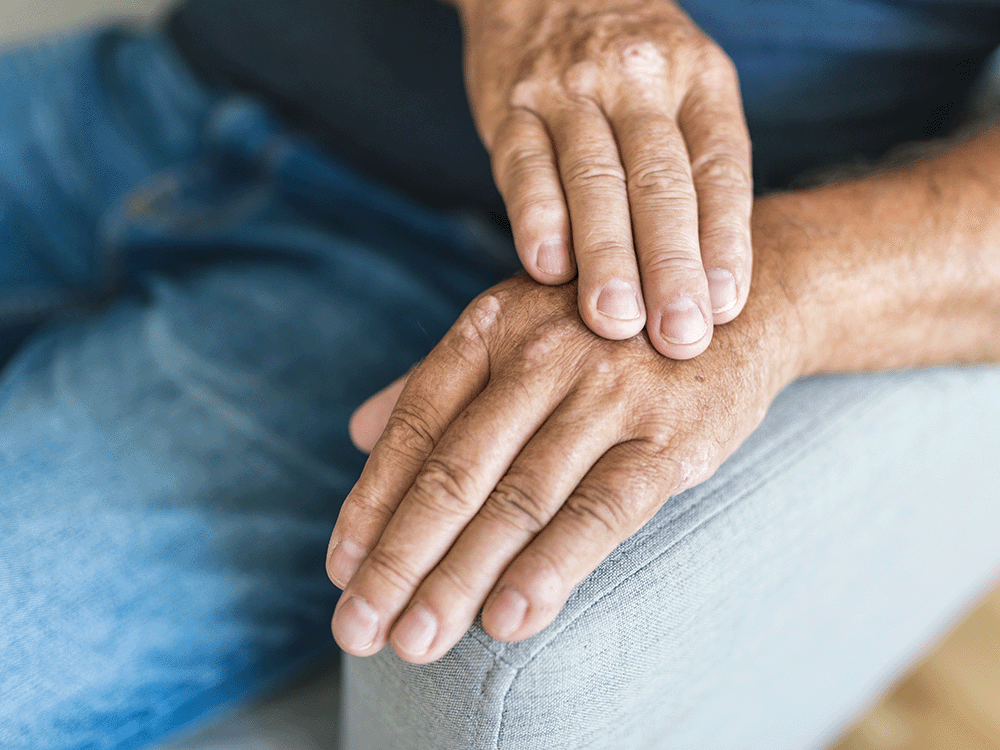 Ruky staršieho muža s prejavmi psoriázy ochorenia kože